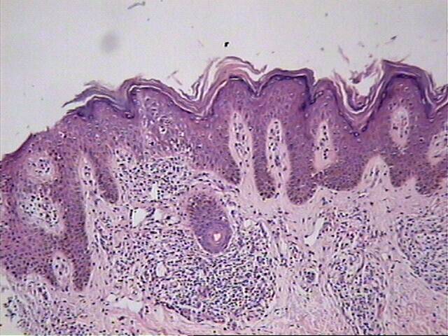 Fig.1 Aspecto de Dermatitis crnica psoriasiforme - <div style=